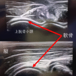 少年野球の肘のケガ(離断性骨軟骨炎)