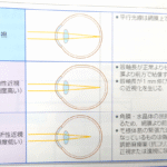 大人の近視