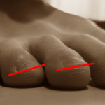 足の小指がねじれている？
