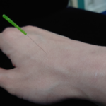 美容鍼について