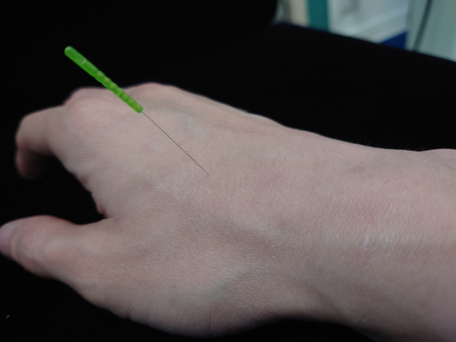 美容鍼について