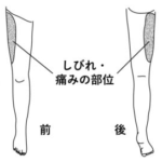 大腿部外側面の神経痛